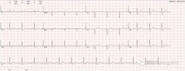 窦性心律大致正常心电图_http://www.jzs.cc_发现_第1张